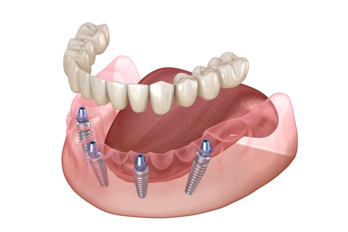 All-On-4 İmplant Tekniği